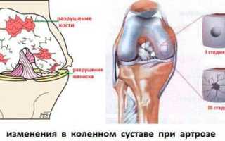 Лечение коленного артроза