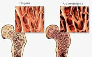 Как проявляется остеопороз
