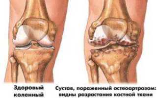 Хрустят суставы ног