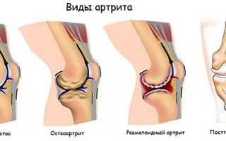 Артрит 2 степени