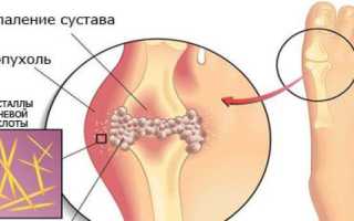 Может ли при подагре быть температура