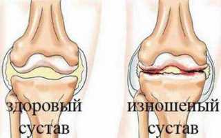 Гонартроз коленного сустава симптомы