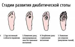 Лечение артроза тазобедренного сустава в домашних условиях