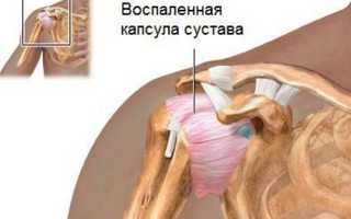 Периартроз лечение