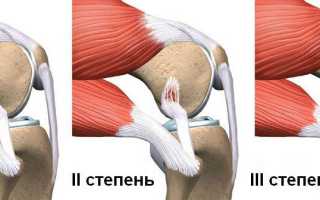 Порваны связки коленного сустава лечение