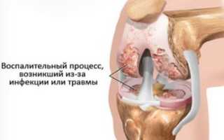 Болит нога сзади колена