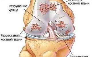 Деформирующий артроз лечение
