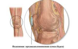 Инфрапателлярный бурсит