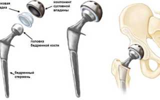 Эндопротез тазобедренного