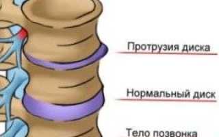 Протрузия шейного отдела позвоночника