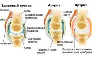 Что такое артрит артроз