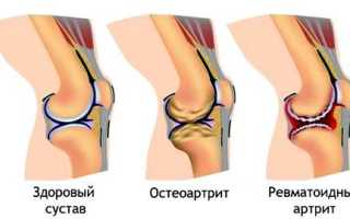 Ломит колени причины